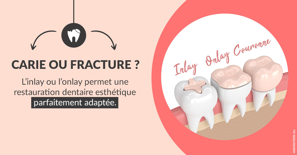 https://dr-gonnet-laurent.chirurgiens-dentistes.fr/T2 2023 - Carie ou fracture 2