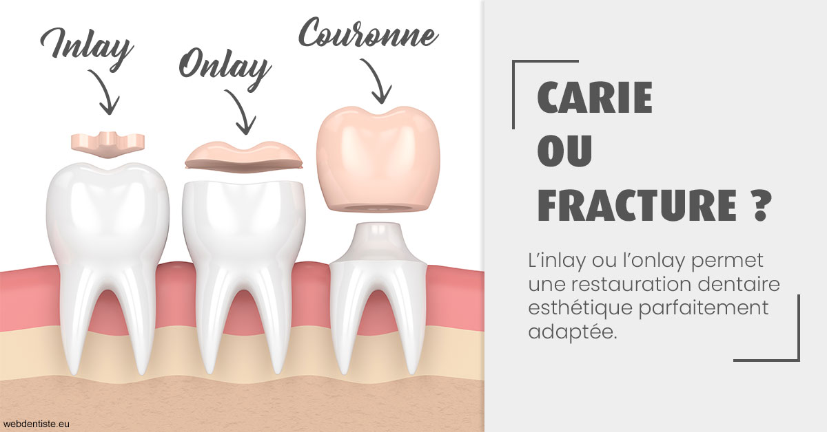 https://dr-gonnet-laurent.chirurgiens-dentistes.fr/T2 2023 - Carie ou fracture 1