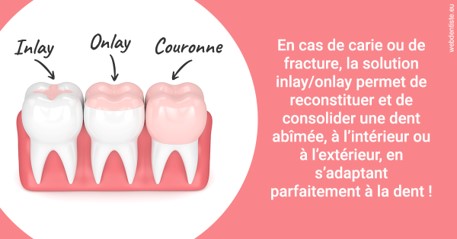 https://dr-gonnet-laurent.chirurgiens-dentistes.fr/L'INLAY ou l'ONLAY 2