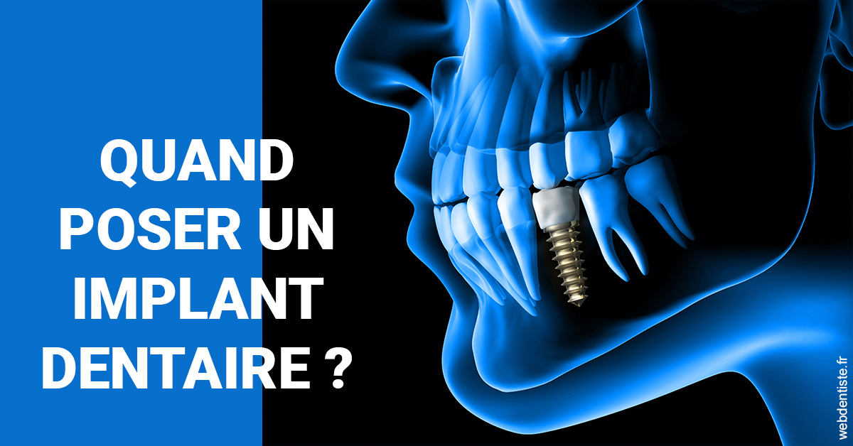 https://dr-gonnet-laurent.chirurgiens-dentistes.fr/Les implants 1