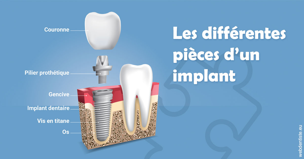 https://dr-gonnet-laurent.chirurgiens-dentistes.fr/Les différentes pièces d’un implant 1